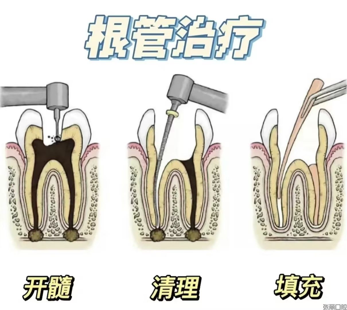 根管治療十